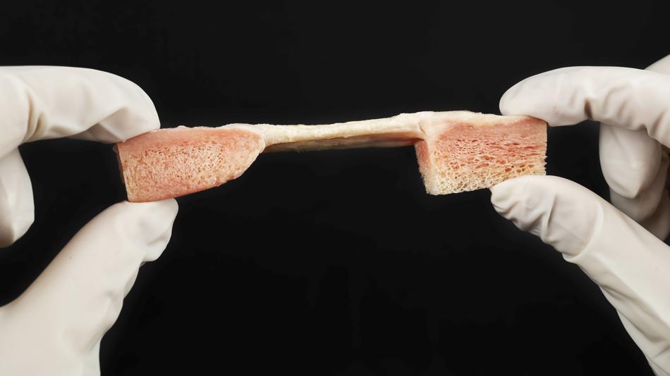 Zwei Hände die ein Patella Ligament halten