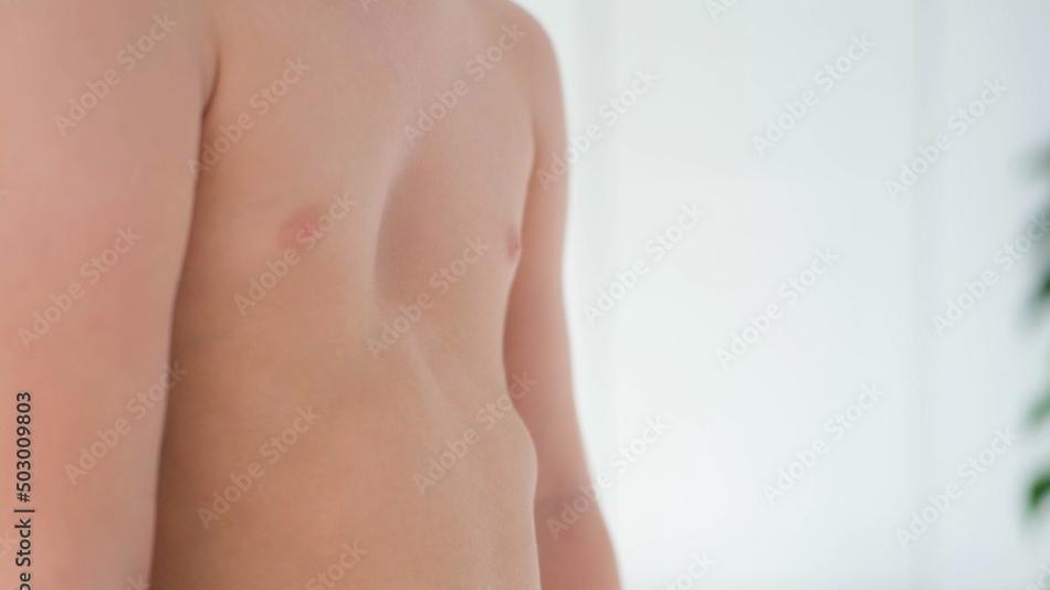 A child with a pectus excavatum. Rickets is a consequence of vitamin D deficiency.