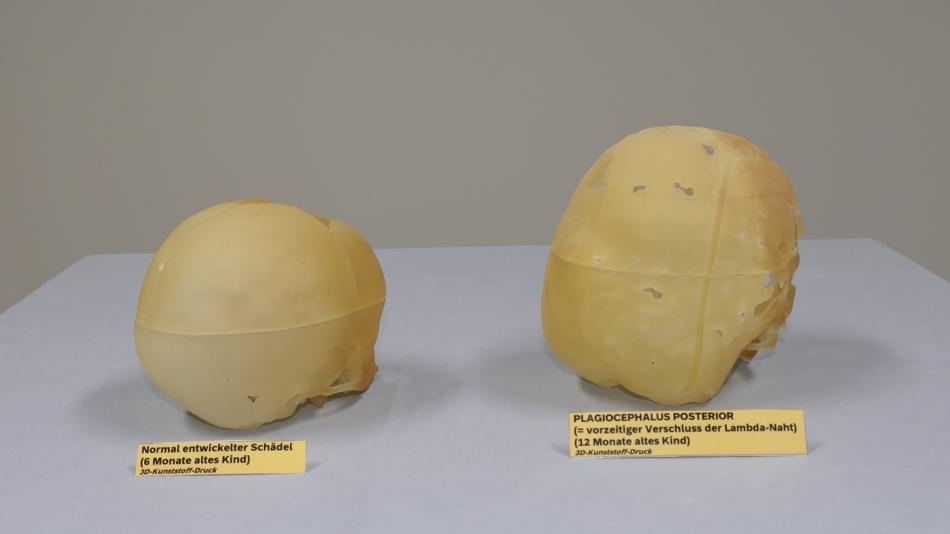 Plagiocephalus posterior