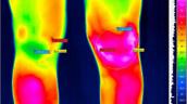 Infrarotaufnahme Knie mit Angabe Temperaturen