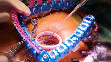 Mikroinvasive Chirurgie am Herzen