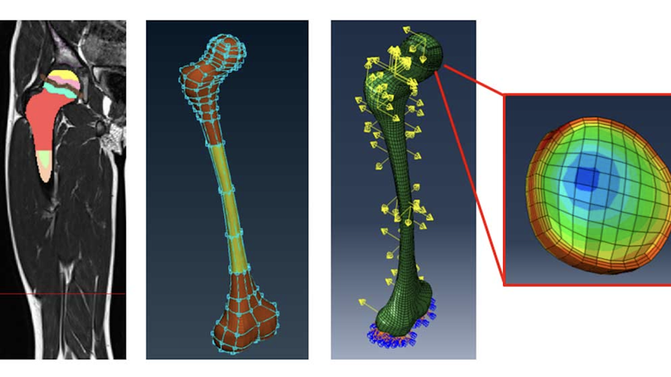 Knochenwachstum aufgrund einwirkender Kräfte