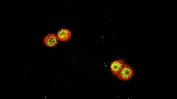 Krebszellen unter dem Mikroskop.