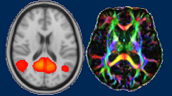 Brain MRI