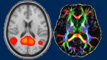 Brain MRI