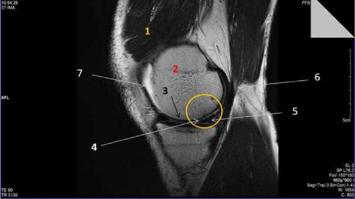 Mini-Magnet-Resonanz Experimente und Meniskus-Schaden in MR-Bildern