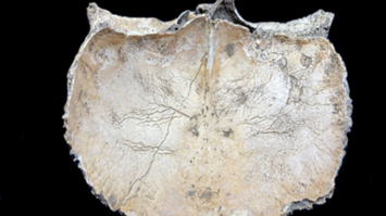 Veränderungen an der Schädelinnenseite in Form von Knochenneubildungen sowie ausgeprägter Gefäßabdrücke, die auf eine Gehirnhautentszündung hindeuten