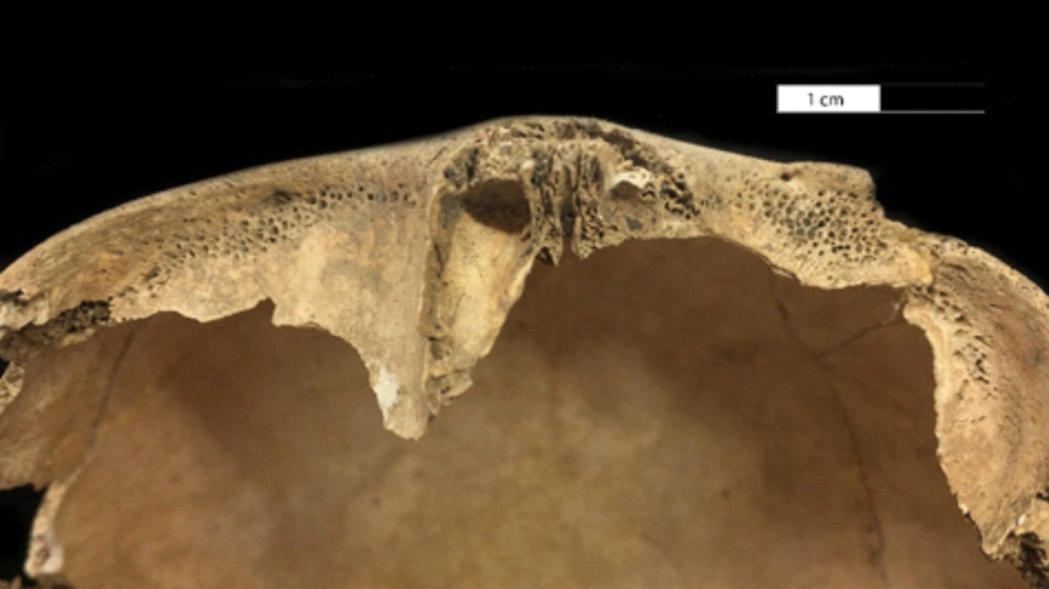 porotische Veränderungen an den Orbitadächern, vermutlich bedingt durch Eisenmangel