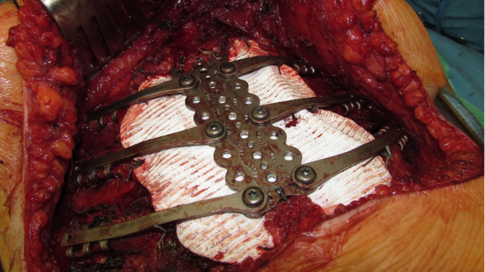 Thoraxwand-Resektionen