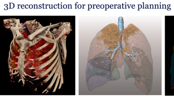 Anatomische Segmentresektion der Lunge – Planung und Operation