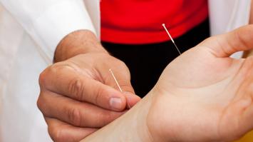 Akupunktur