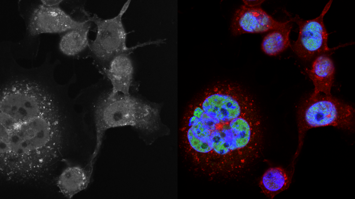 Abbildung Krebszellen