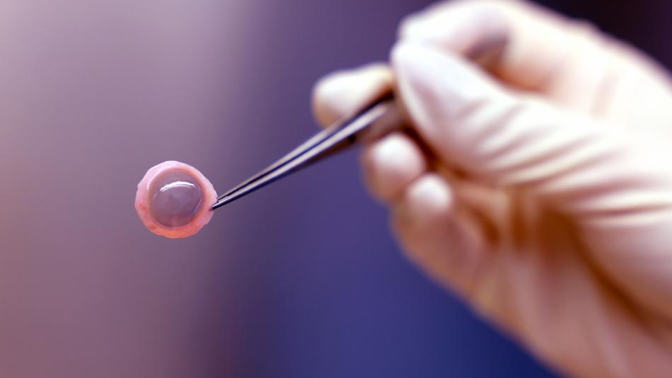 Cornea die mit einer Pinzette gehalten wird