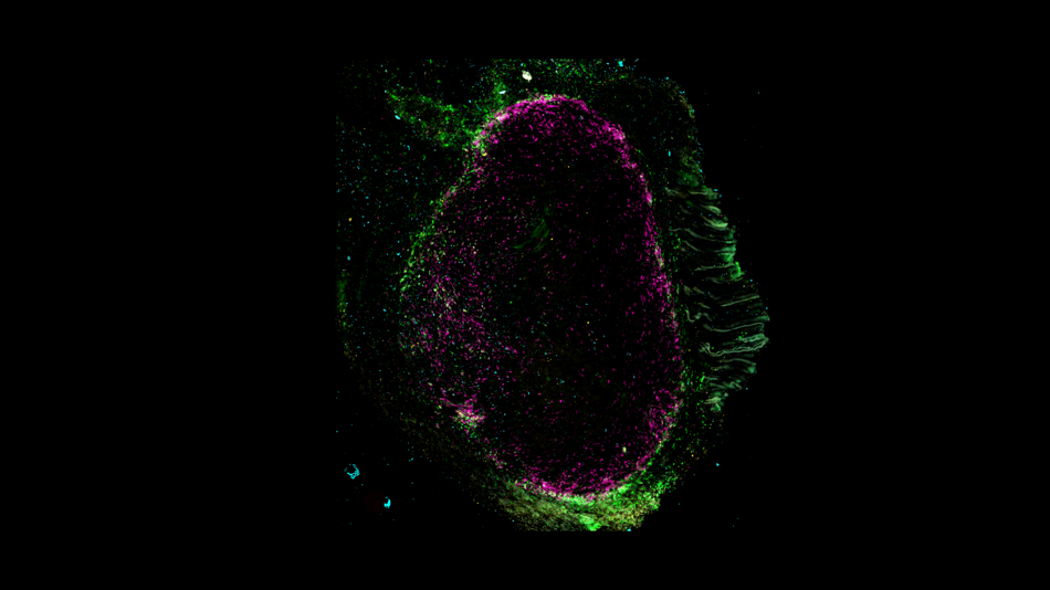 Angefärbte Immunzellen im Tumor